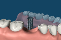 Dental Implants