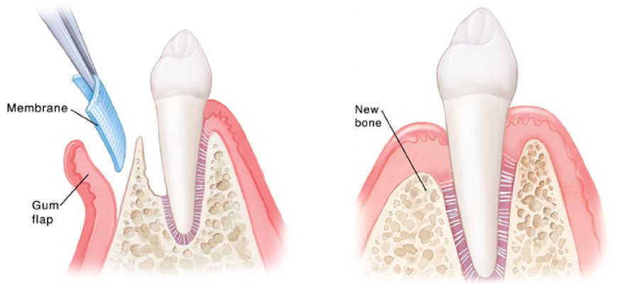 guided tissue regeneration